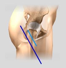 minimally-hip-replacement